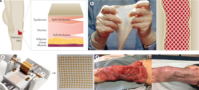 A Brief Overview of Burn Injuries