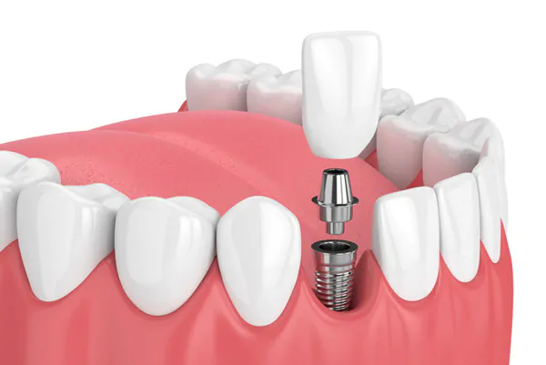 tooth implant
