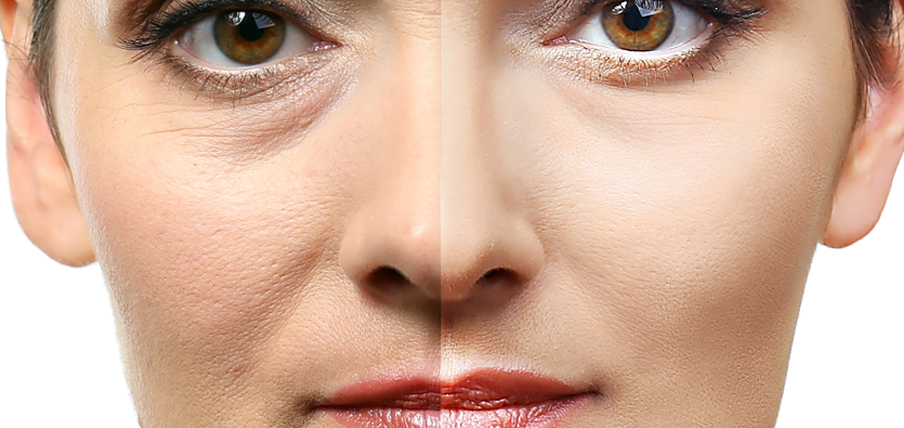 Non-Surgical Rhinoplasty