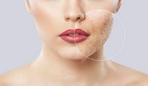 SkinPen Microneedling