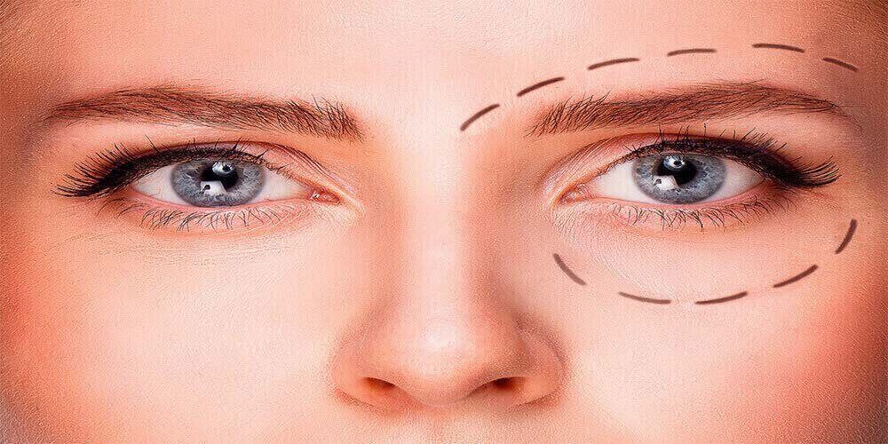 Eyelid Surgery Here's What You Need to Know