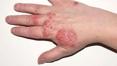 Top causes and symptoms of skin diseases with associated dermatological treatment