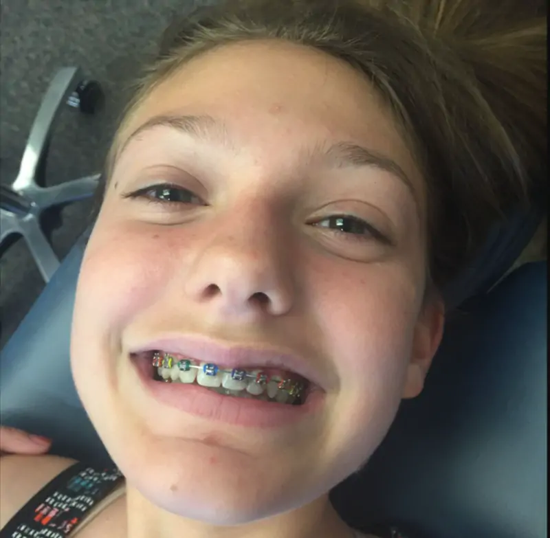 Braces Girl Video Reddit All the Details You Need to Know! Exorbit