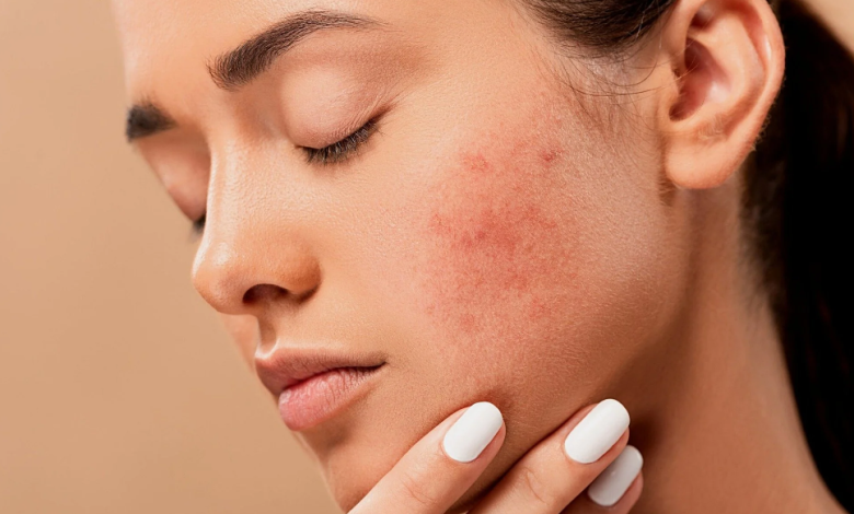 How to get rid of acne?