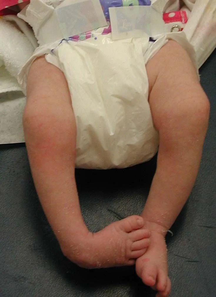 Newborn baby with clubfoot
