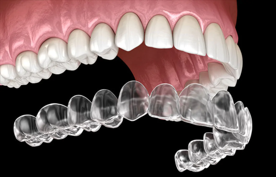 An In-Depth Look at the Factors That Determine Invisalign Treatment Costs
